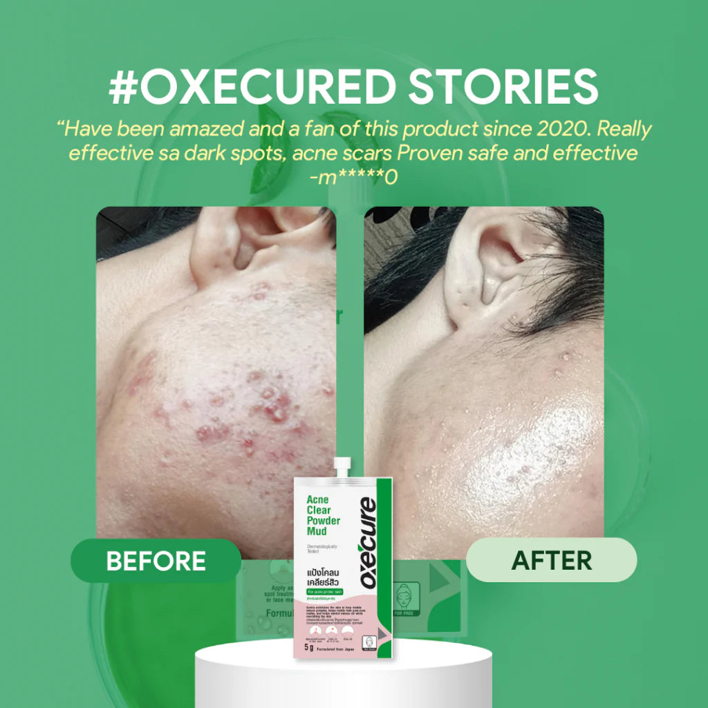 Oxecure Acne Clear Powder Mud