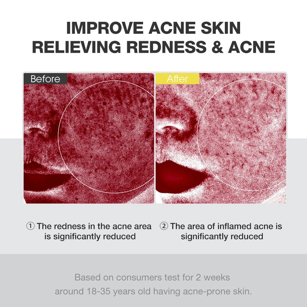 SKINEVER Salicylic Acid Acne Treatment Ice Sleep Masque